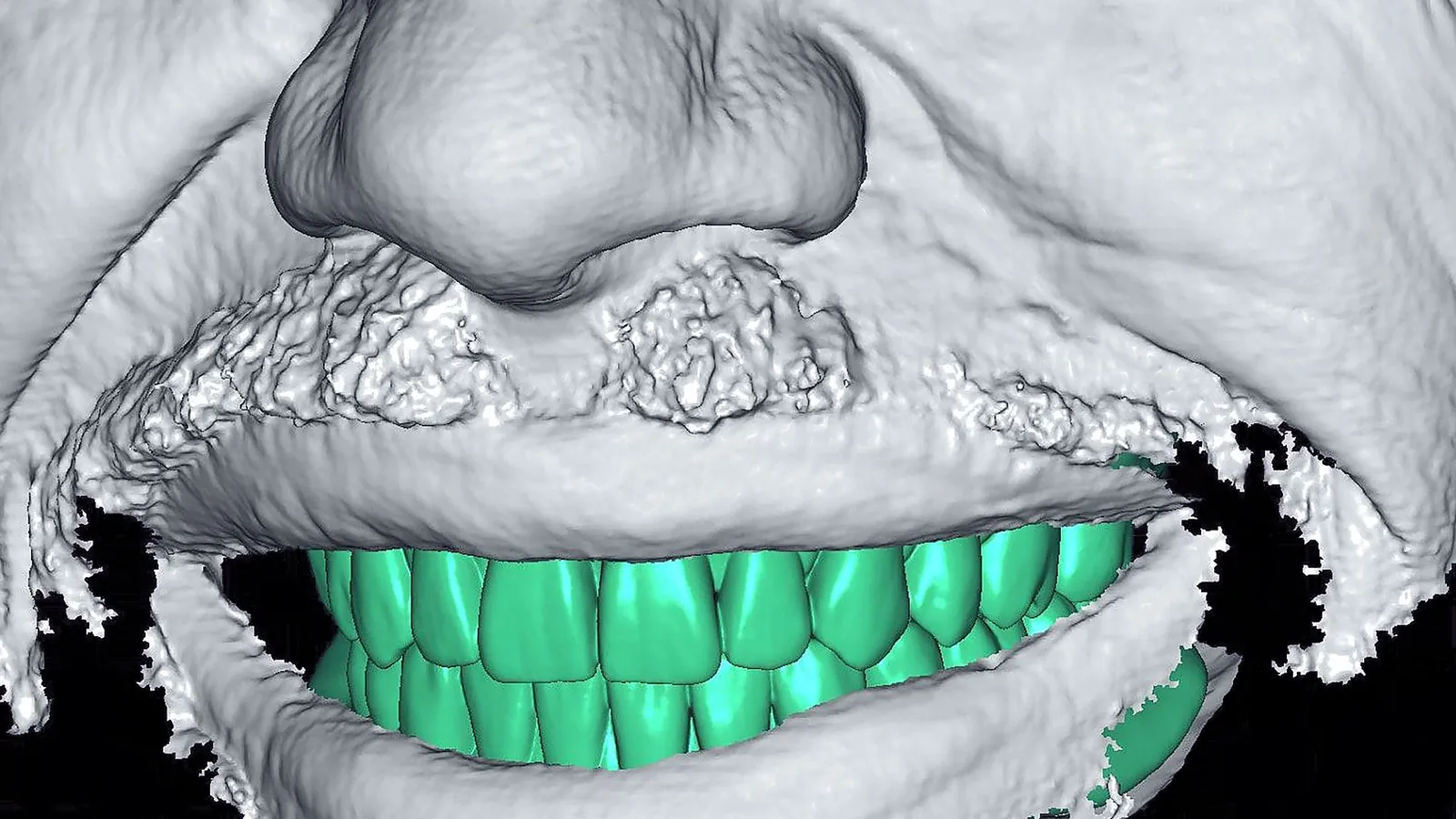A 3D scan of a patient’s face with a planned set of teeth shown in green